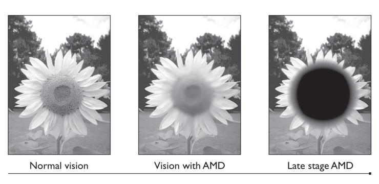 Age-Related Macular Degeneration